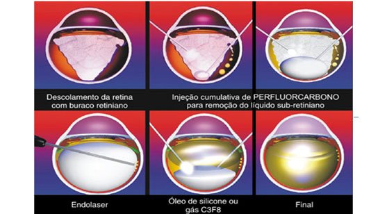 Descolamento da Retina  Oculari Hospital Oftalmológico