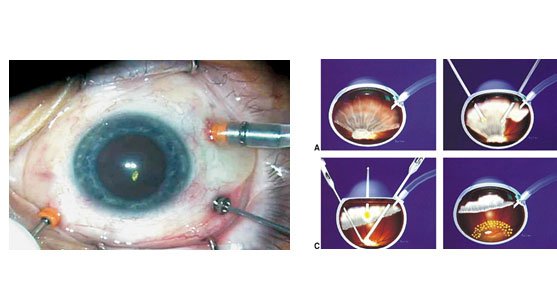 Cirurgia e Tratamento para Descolamento de Retina - COHR