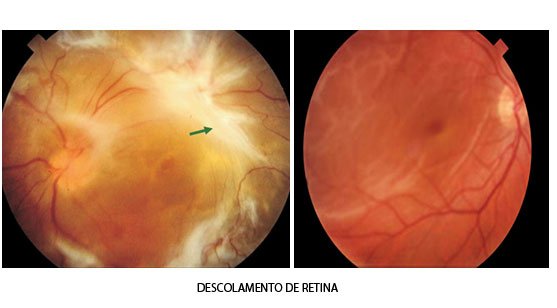 DESCOLAMENTO DE RETINA