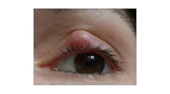 Calázio e hordéolo (terçol) - Distúrbios oftalmológicos - Manuais MSD  edição para profissionais